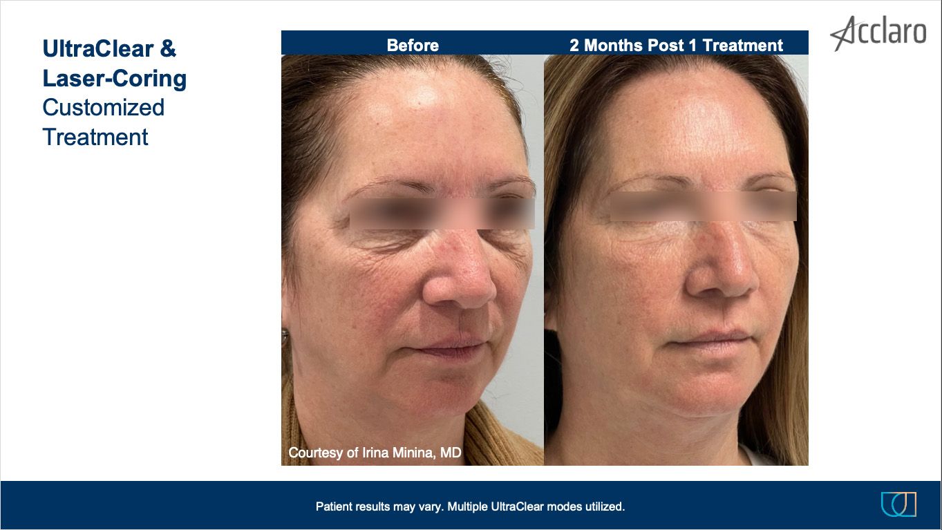 UltraClear Laser Performed by Irina Minina