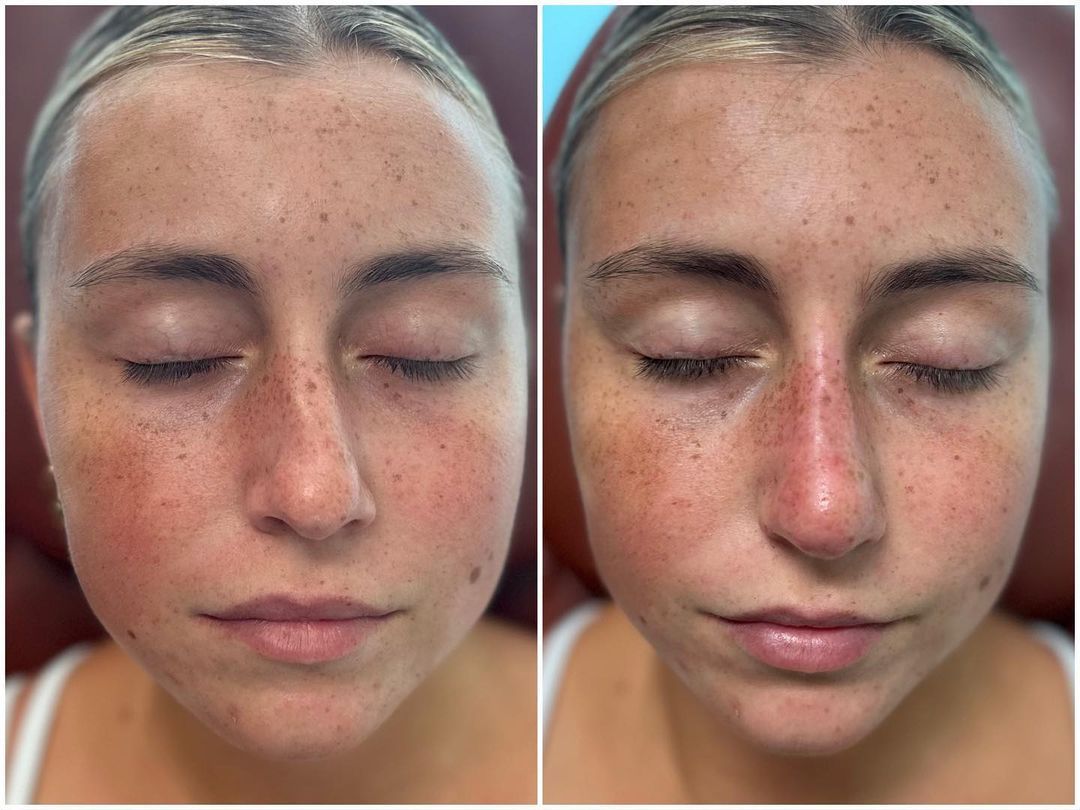 Rhinoplasty by Dr. Baccaro