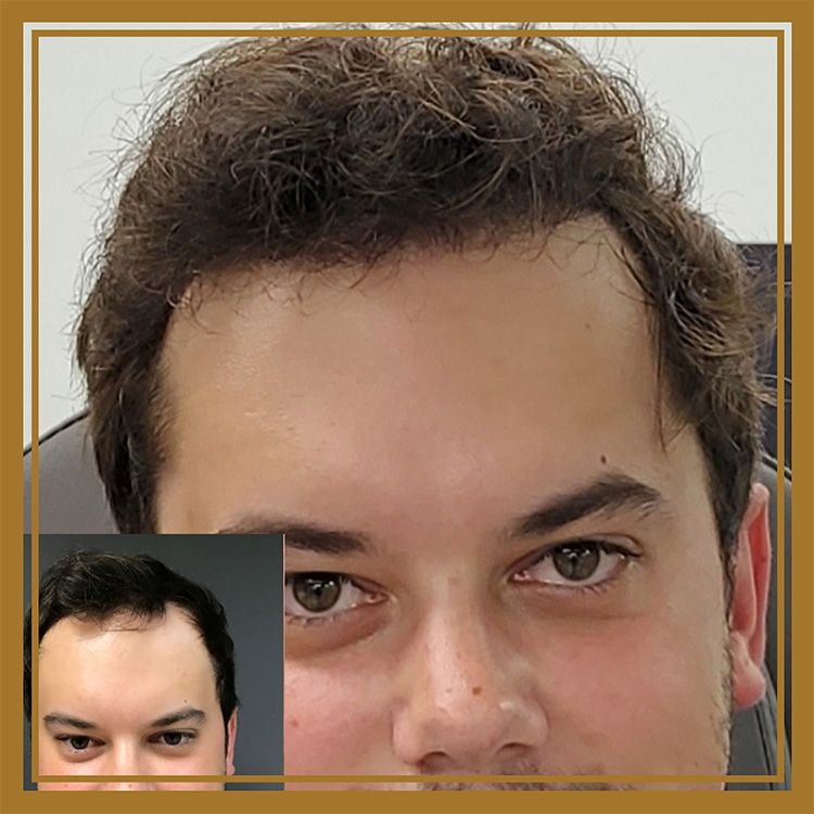 Hair Restoration by Dr. Wisiorek