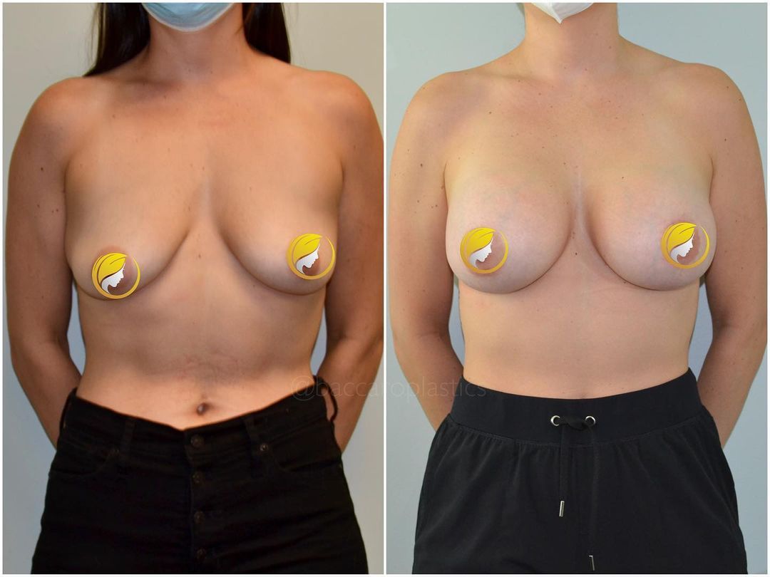 Hybrid Breast Augmentation by Dr. Baccaro