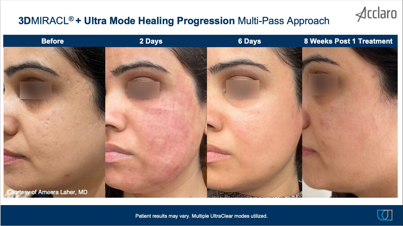 UltraClear Laser Performed by Ameera Laher