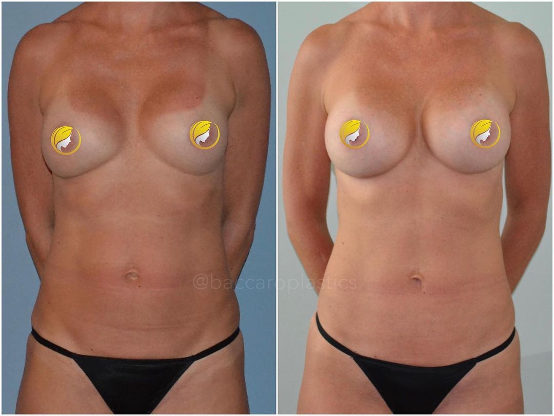 Breast Revision by Dr. Baccaro