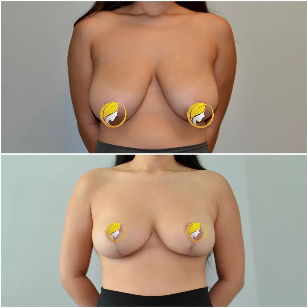 Breast Lift and Reduction by Dr. Baccaro