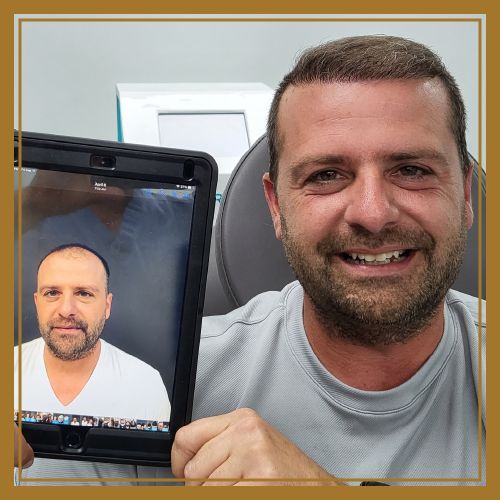 Naples Hair restoration before and after image
