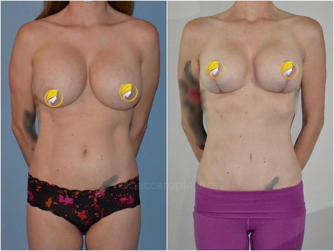 Mommy Makeover by Dr. Baccaro