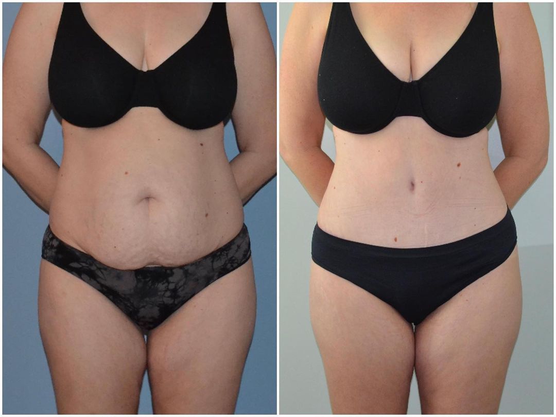 Tummy Tuck & Lipo by Dr. Baccaro
