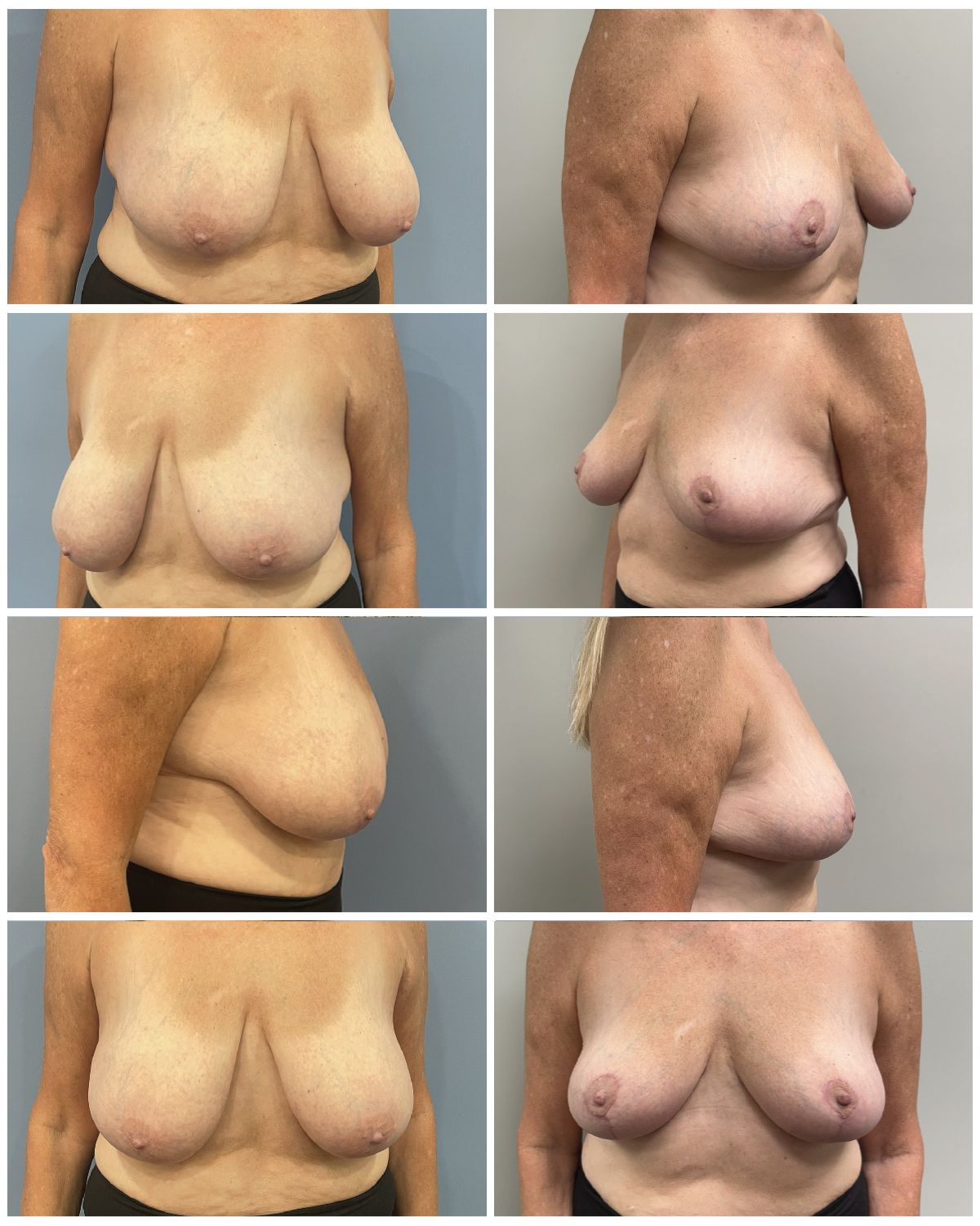 Dr. Walsh – Breast Reduction Patient 4