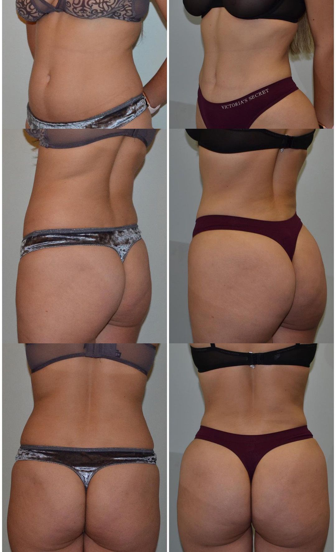 Liposuction by Dr. Leo Baccaro