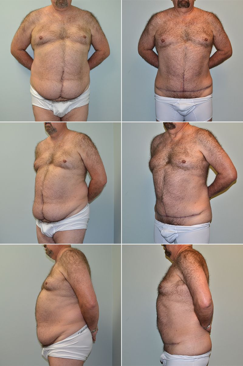 tummy tuck 12