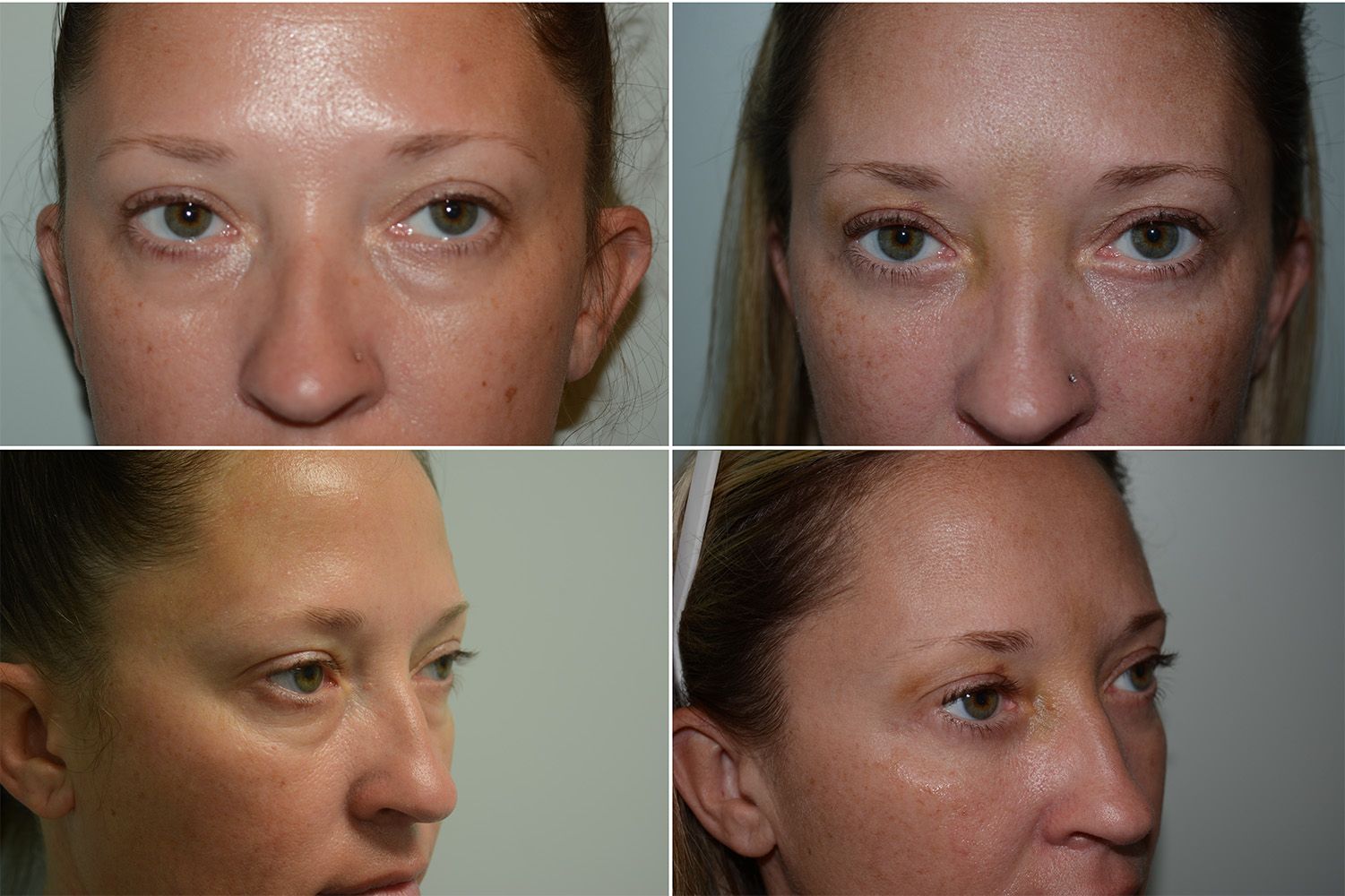 Blepharoplasty by Dr. Gardner