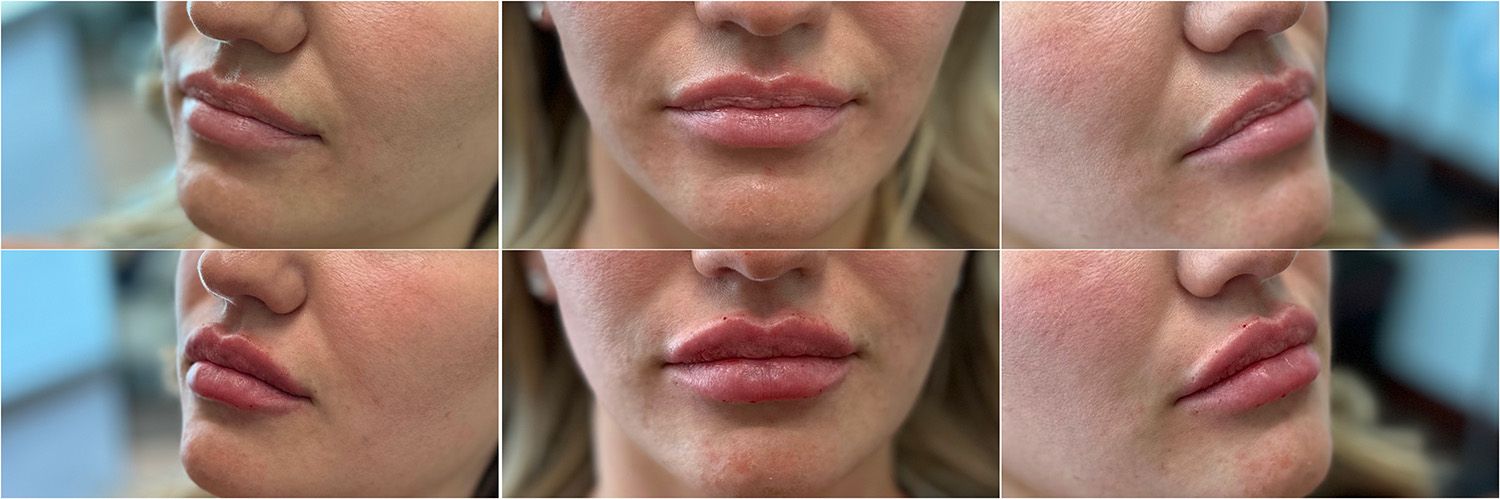 Lip Filler by Dr. Baccaro