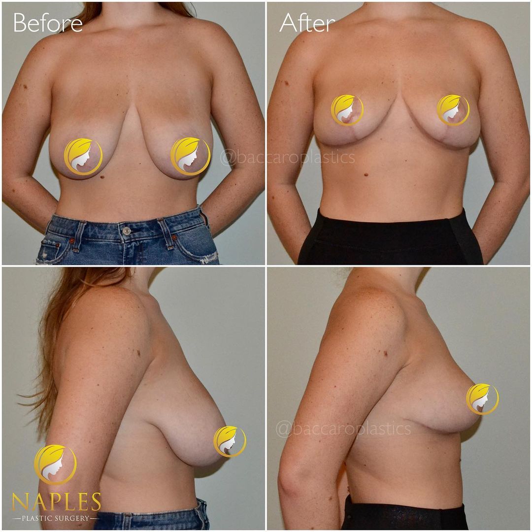Breast Reduction and Lift by Dr. Baccaro