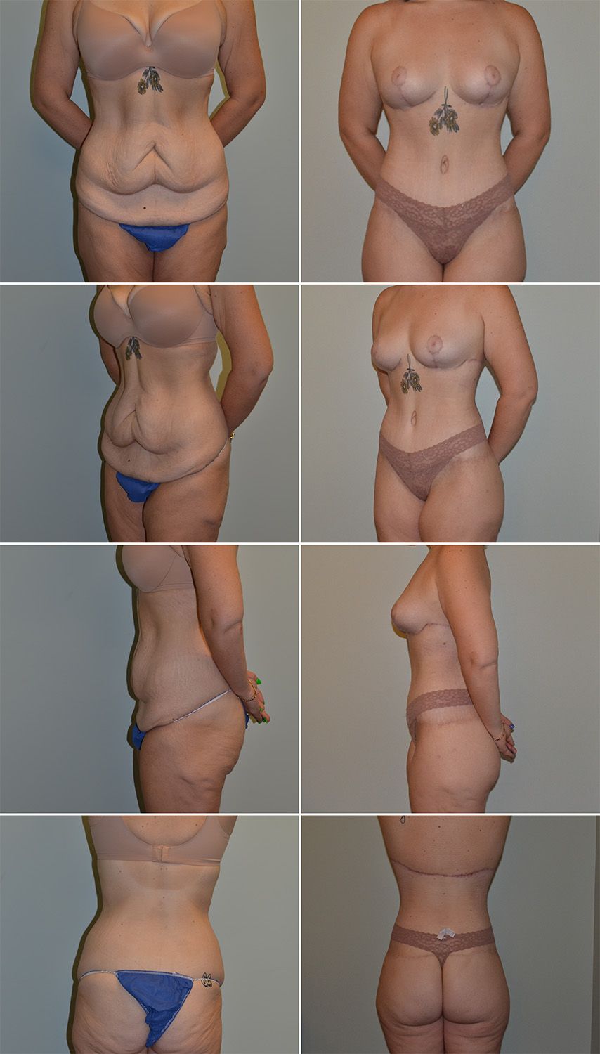 Tummy Tuck Performed by Dr. Baccaro