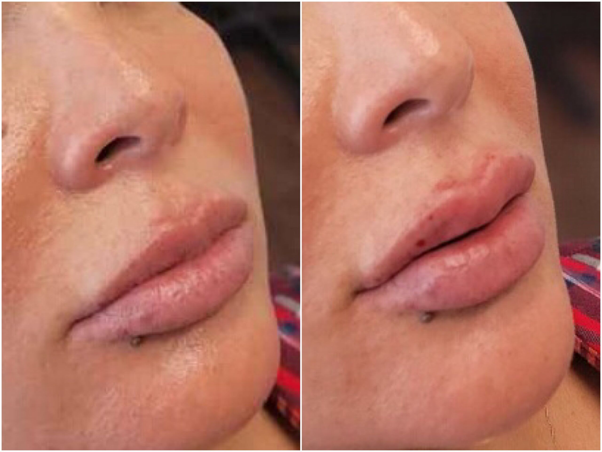 Lip Filler by Dr. Baccaro