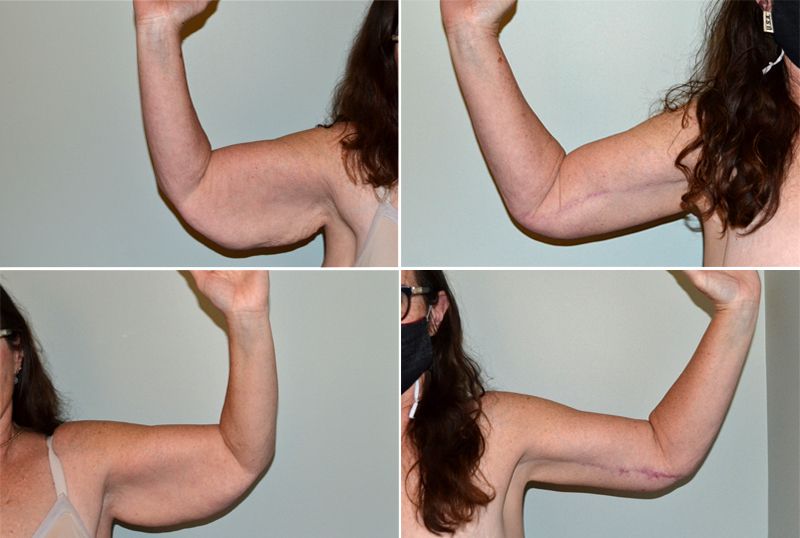 arm lift 02