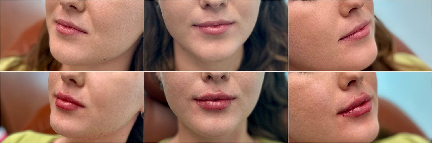 Lip Filler by Dr. Baccaro