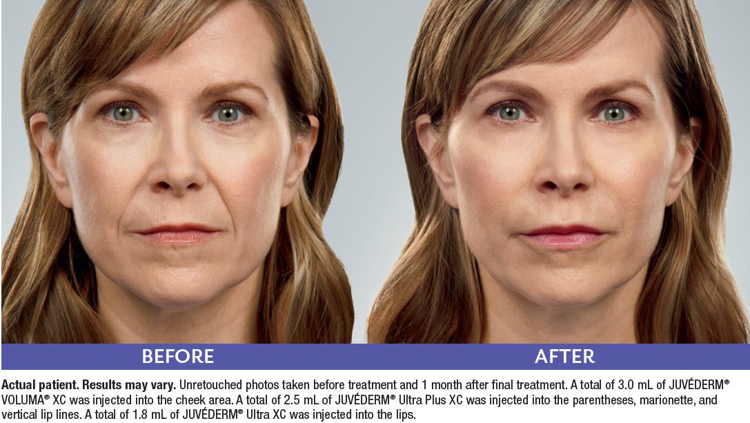 Before and after image showcasing the transformative results of JUVÉDERM® treatment for facial rejuvenation