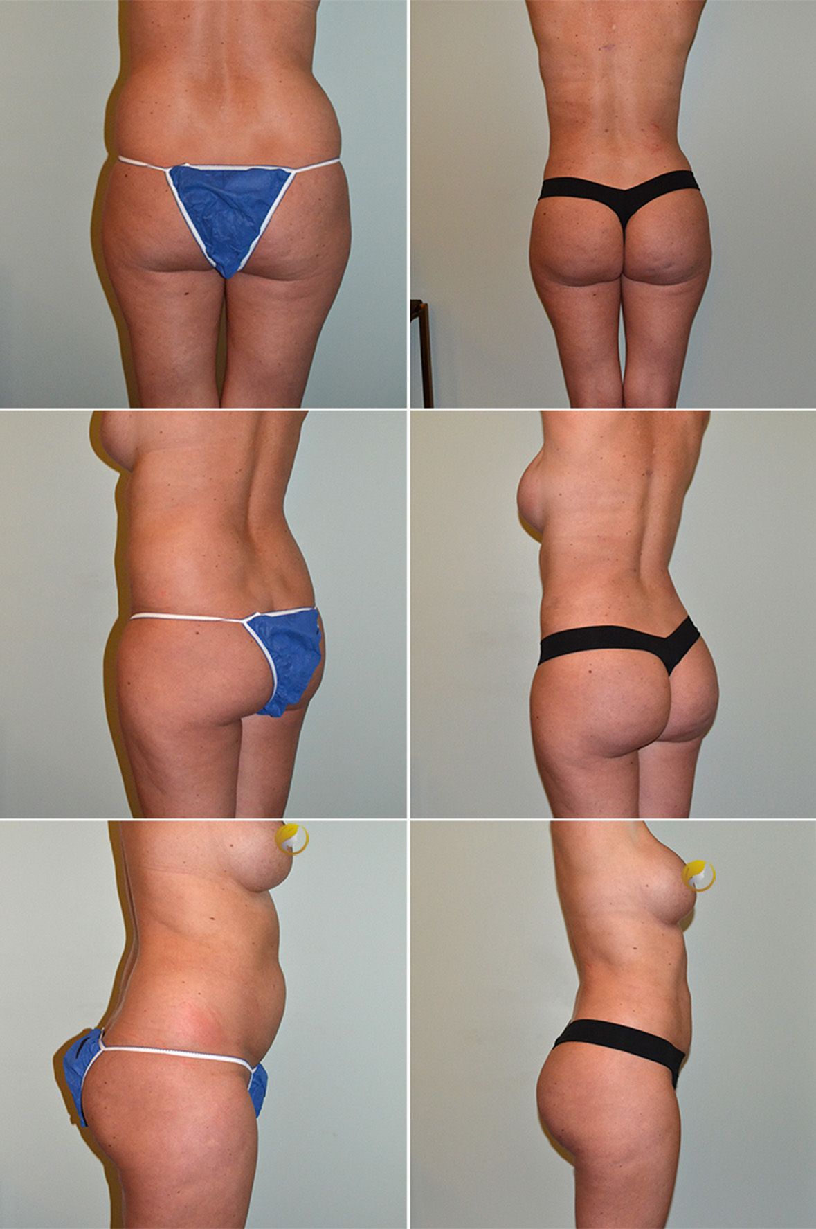 Liposuction by Dr. Leo Baccaro