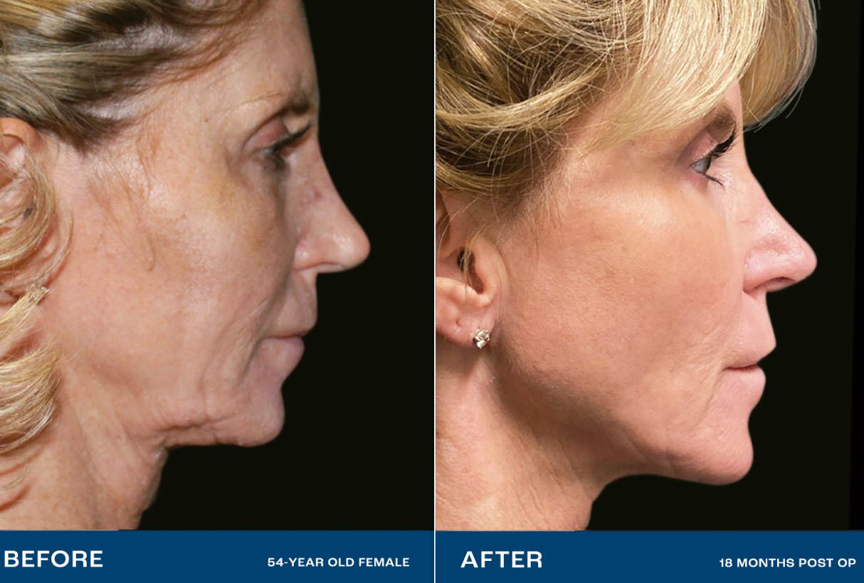 Renuvion skin tightening before and after image