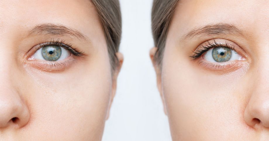 Am I a Candidate for Eyelid Surgery