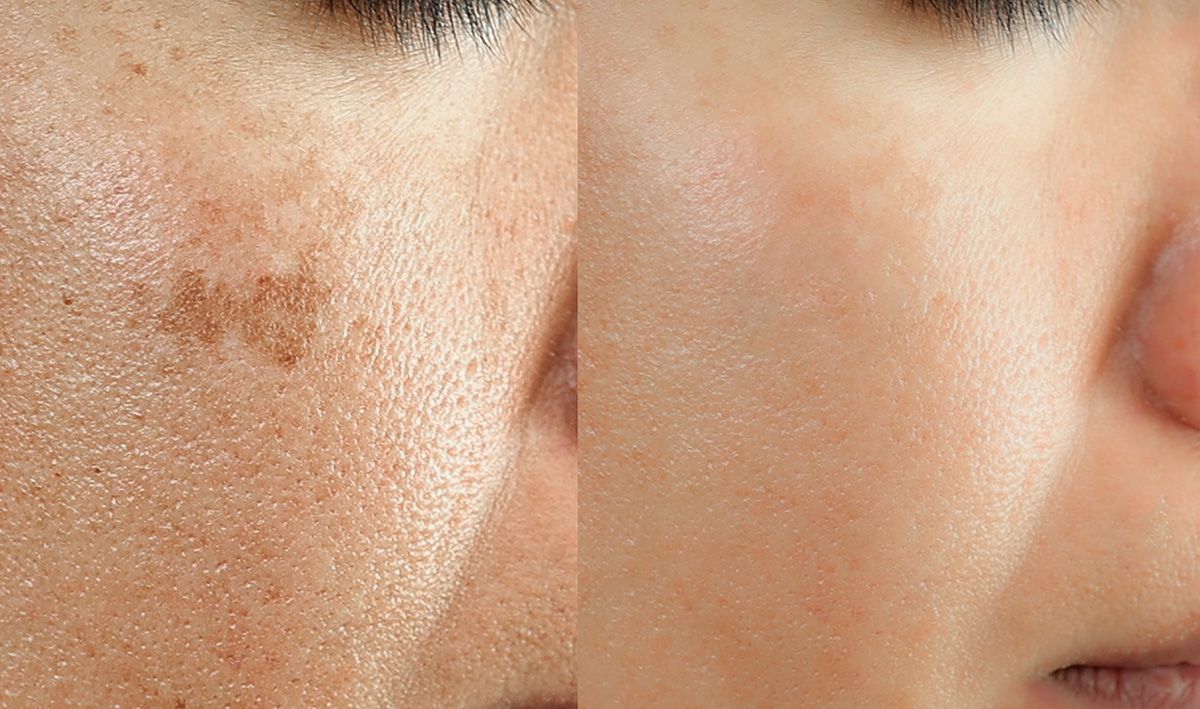 ultraclear-naples-plastic-surgery