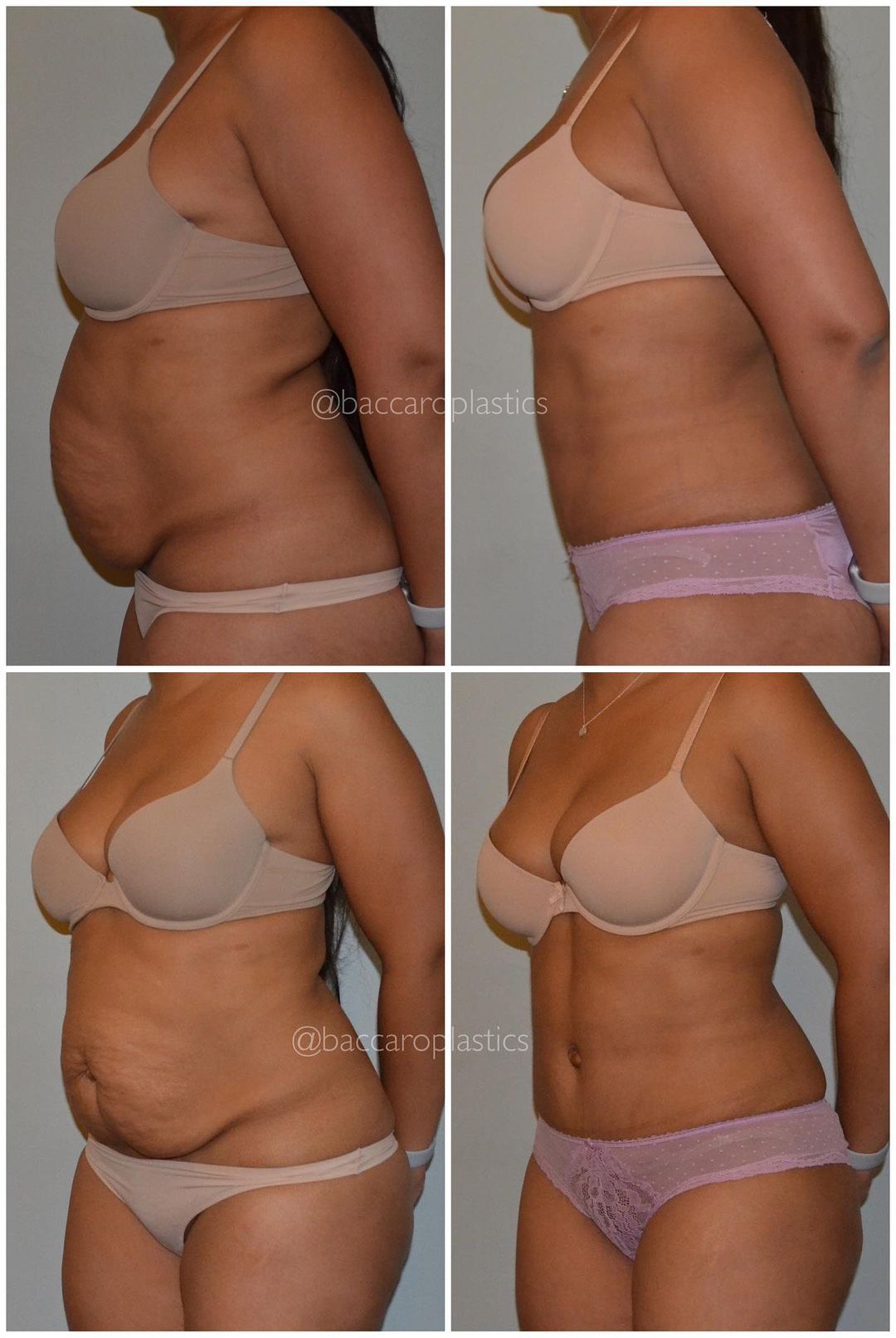 Liposuction by Dr. Leo Baccaro
