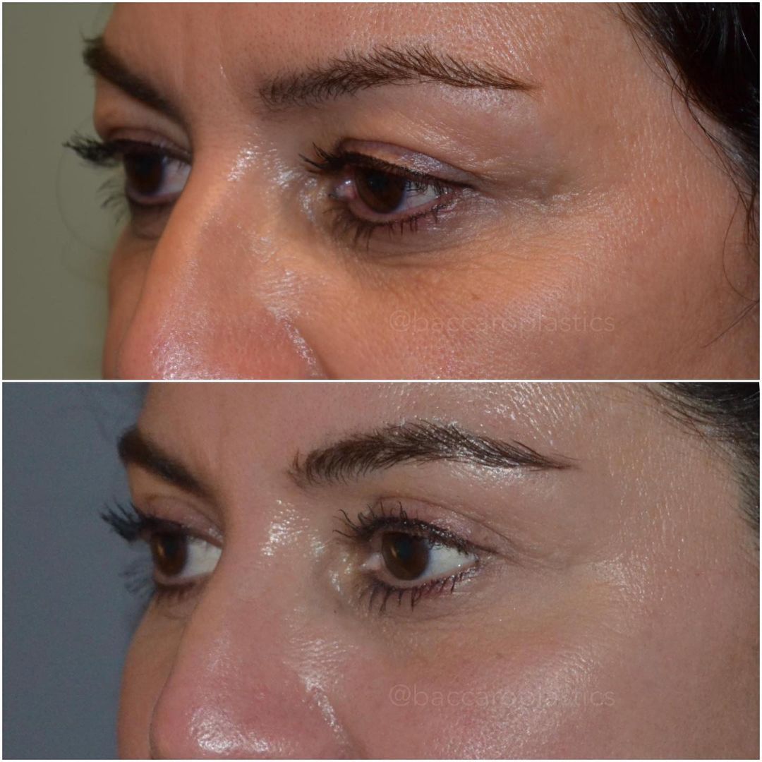 Upper Blepharoplasty by Dr. Baccaro