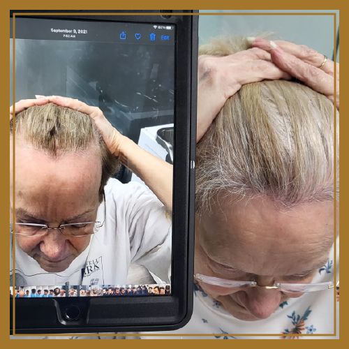 Hair restoration patient Naples, FL