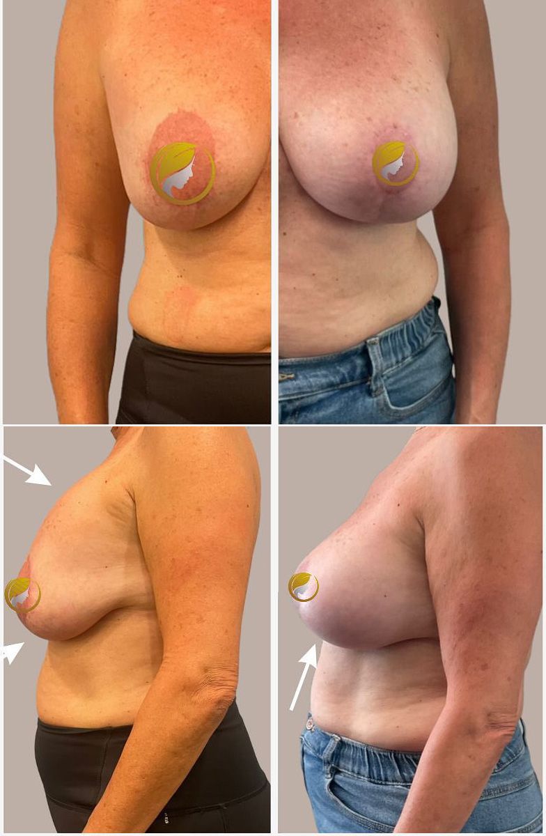 Surgery Performed by Dr. Mark Walsh