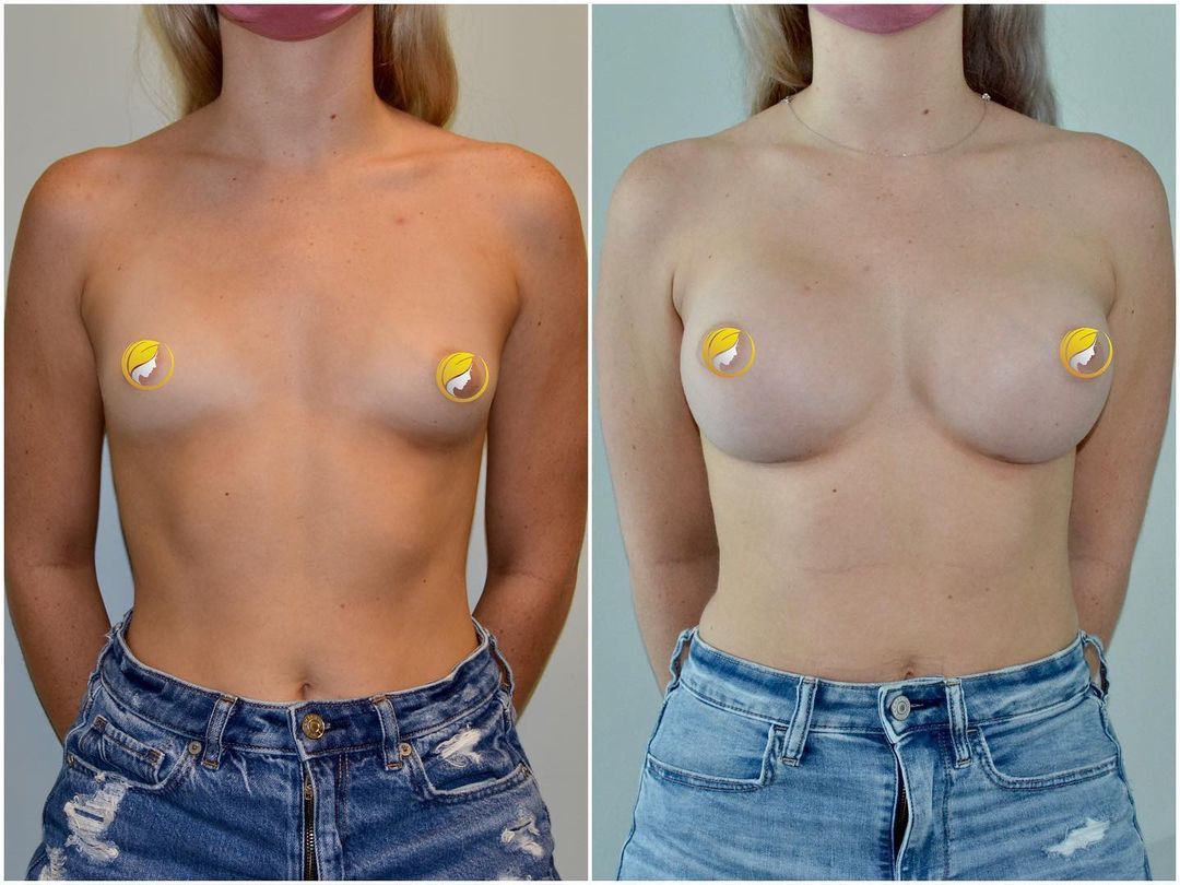 Breast Augmentation by Dr. Baccaro