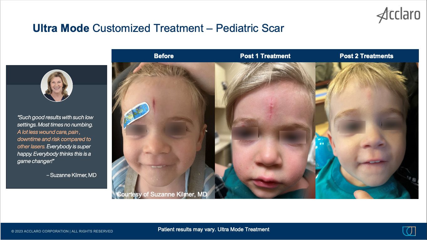 UltraClear Laser Performed by Suzanne Kilmer