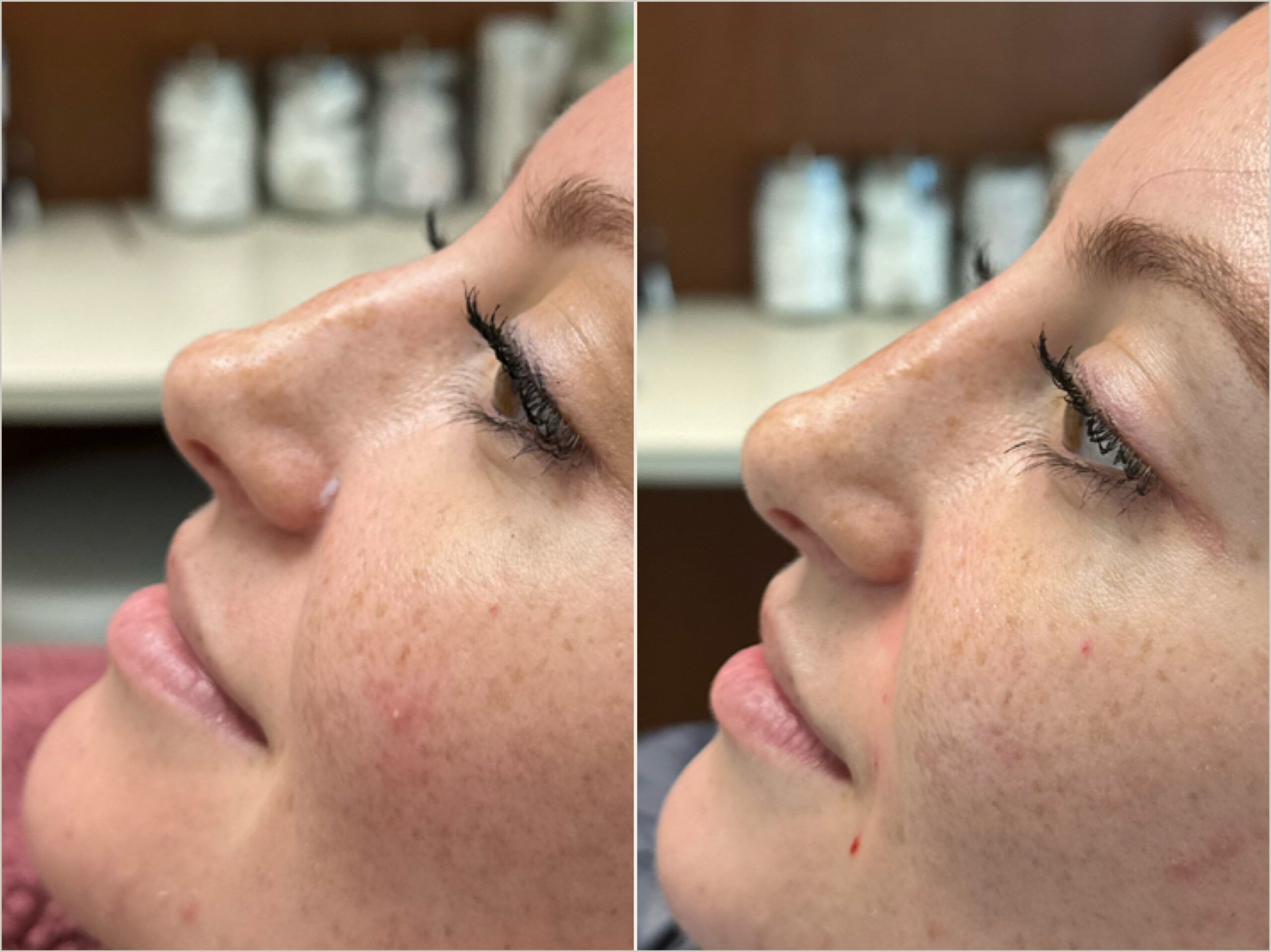 Liquid Rhinoplasty Performed by Dr. Baccaro