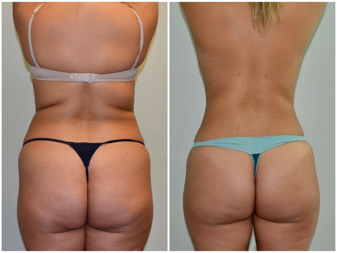 Before & After Buttock Augmentation Gallery - Cosmetic Surgery