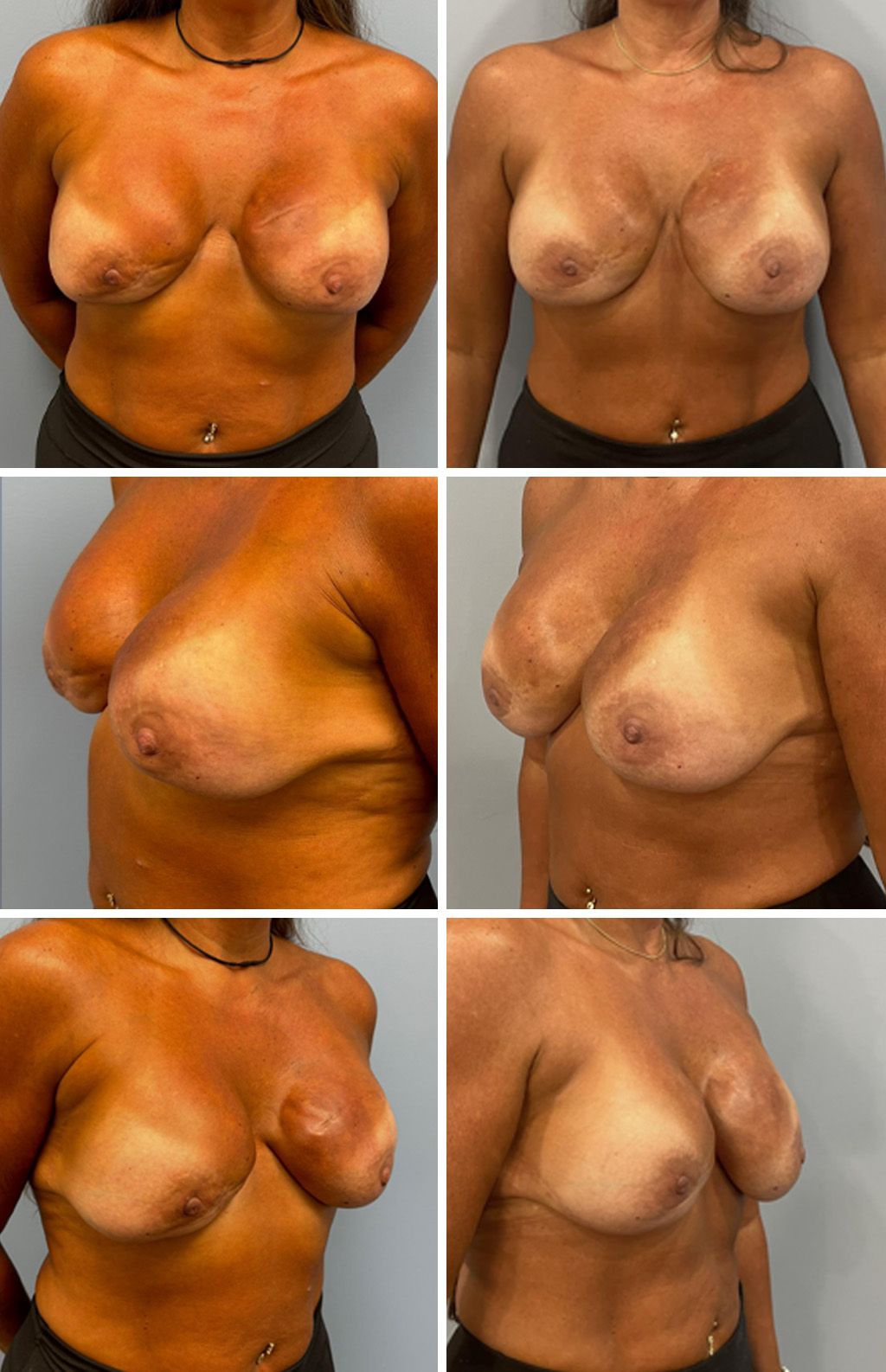 Breast Reconstruction performed by Dr. Bonett