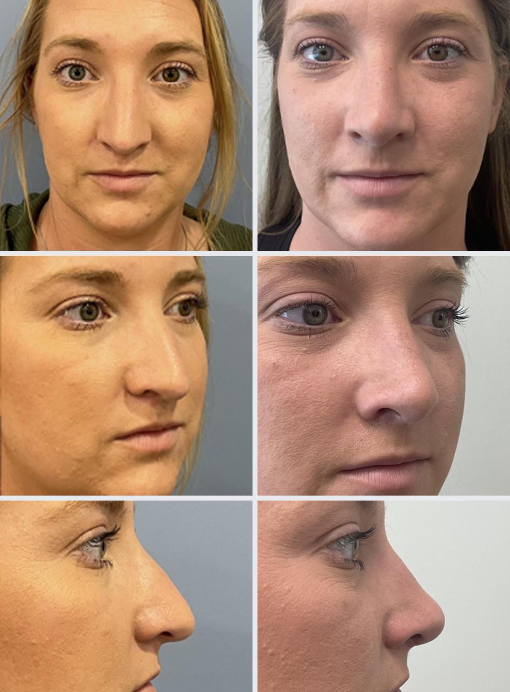 Rhinoplasty Performed by Dr. Bonett