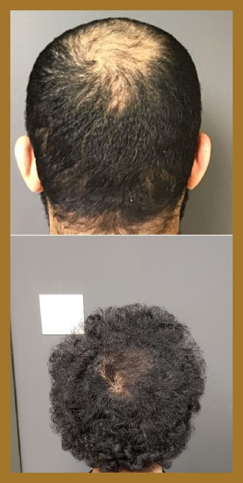 back of head hair loss Hair restoration image