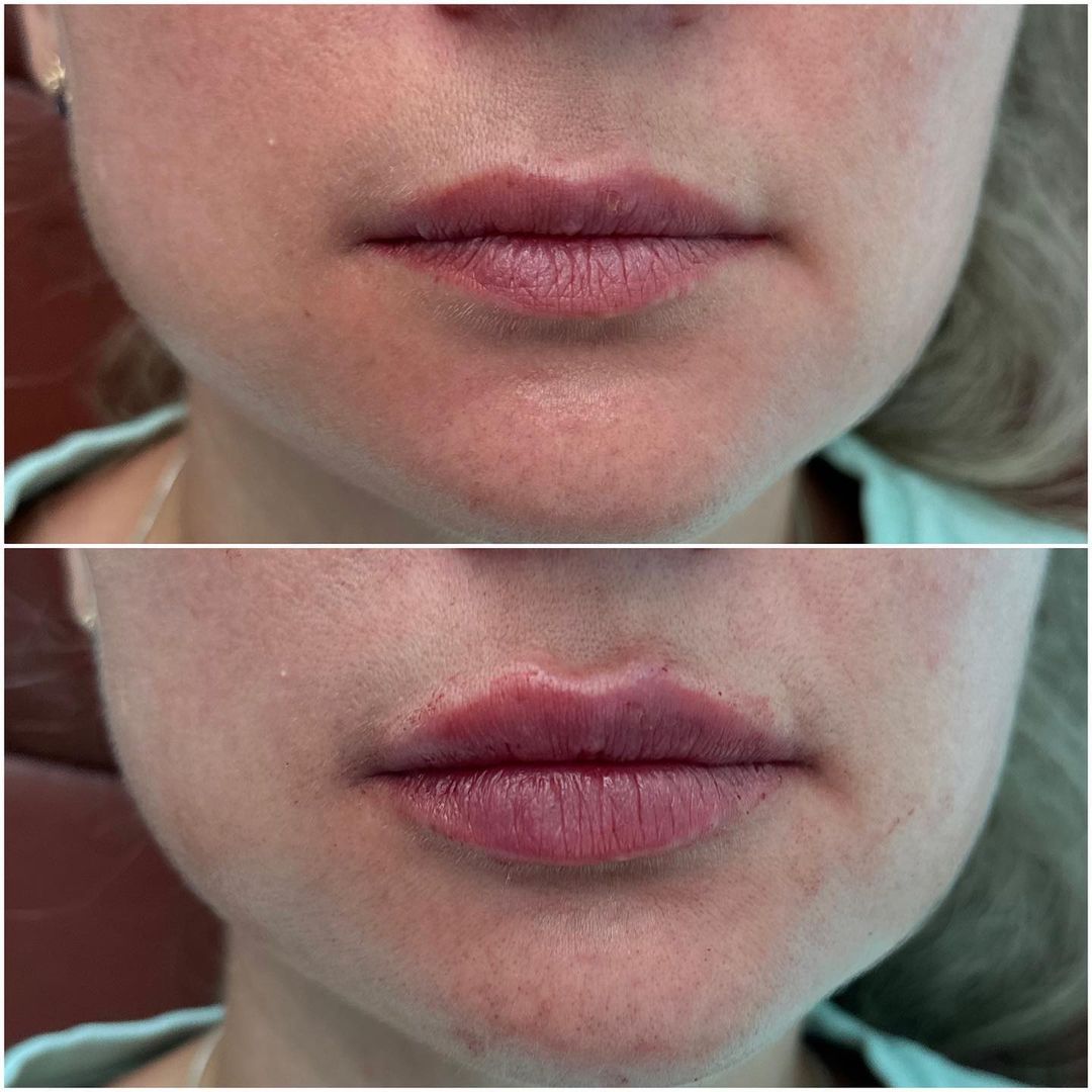 Lip Augmentation by Dr. Baccaro