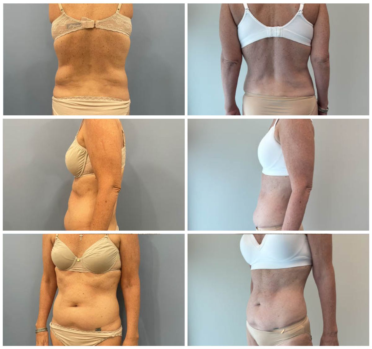 Dr. Walsh – Liposuction Patient 1