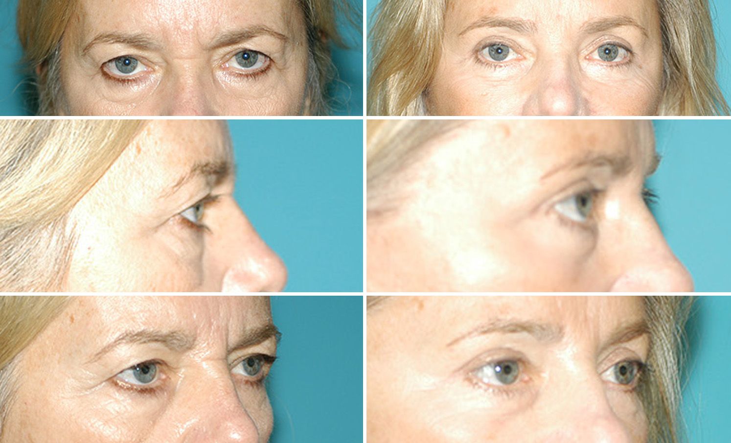 Upper Blepharoplasty by Dr. Gardner