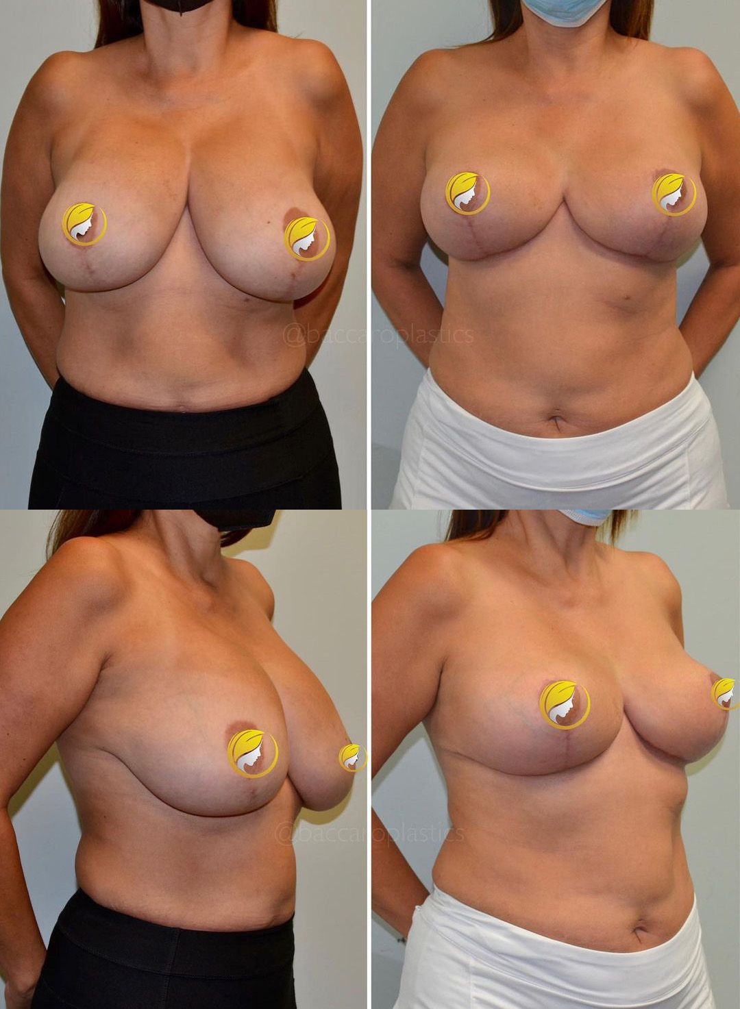 Breast Revision by Dr. Baccaro