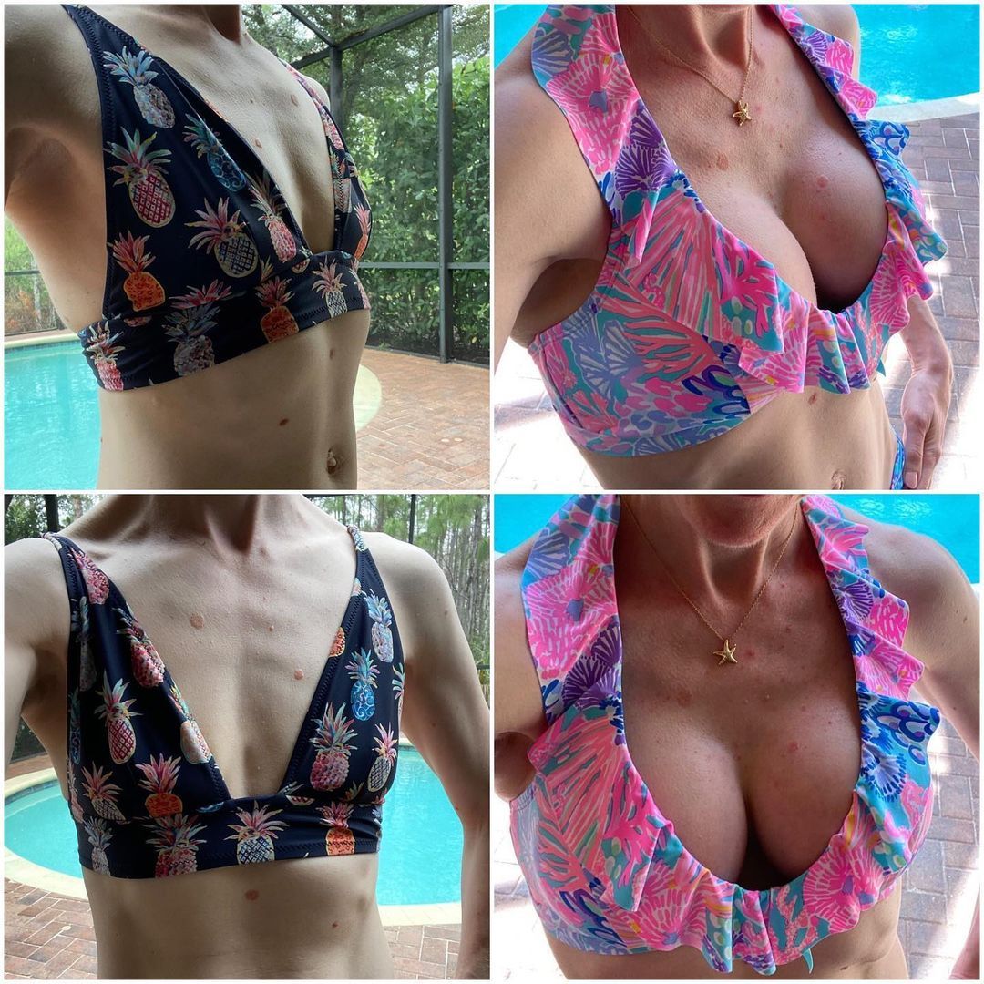 Hybrid Breast Augmentation by Dr. Baccaro