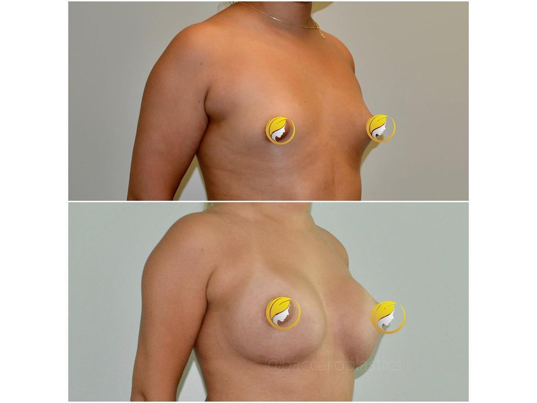 Hybrid Breast Augmentation by Dr. Baccaro