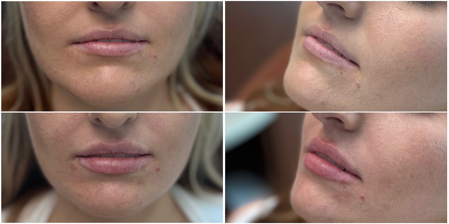 Lip Filler by Dr. Baccaro