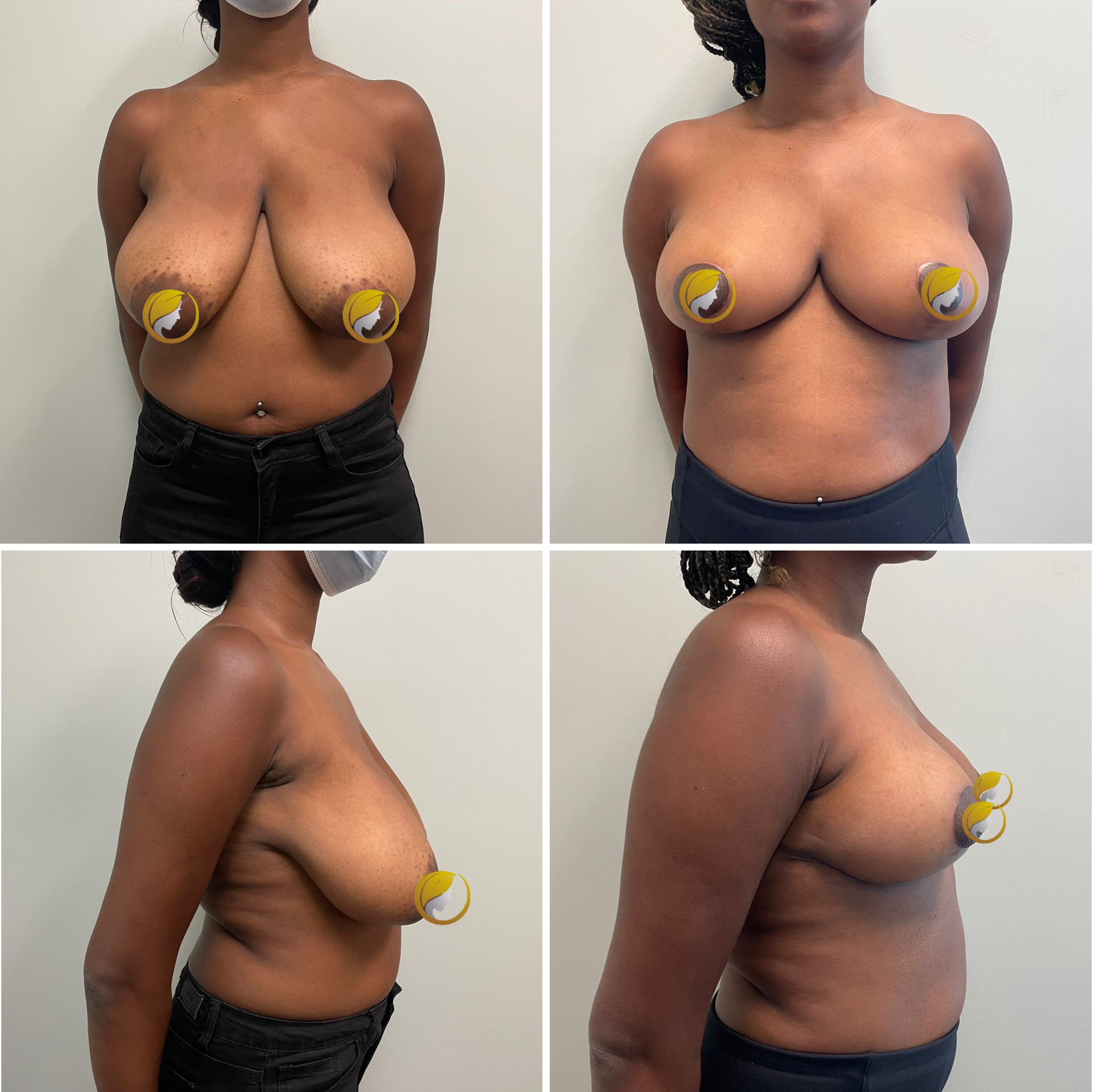 Surgery Performed by Dr. Andrew Bonett