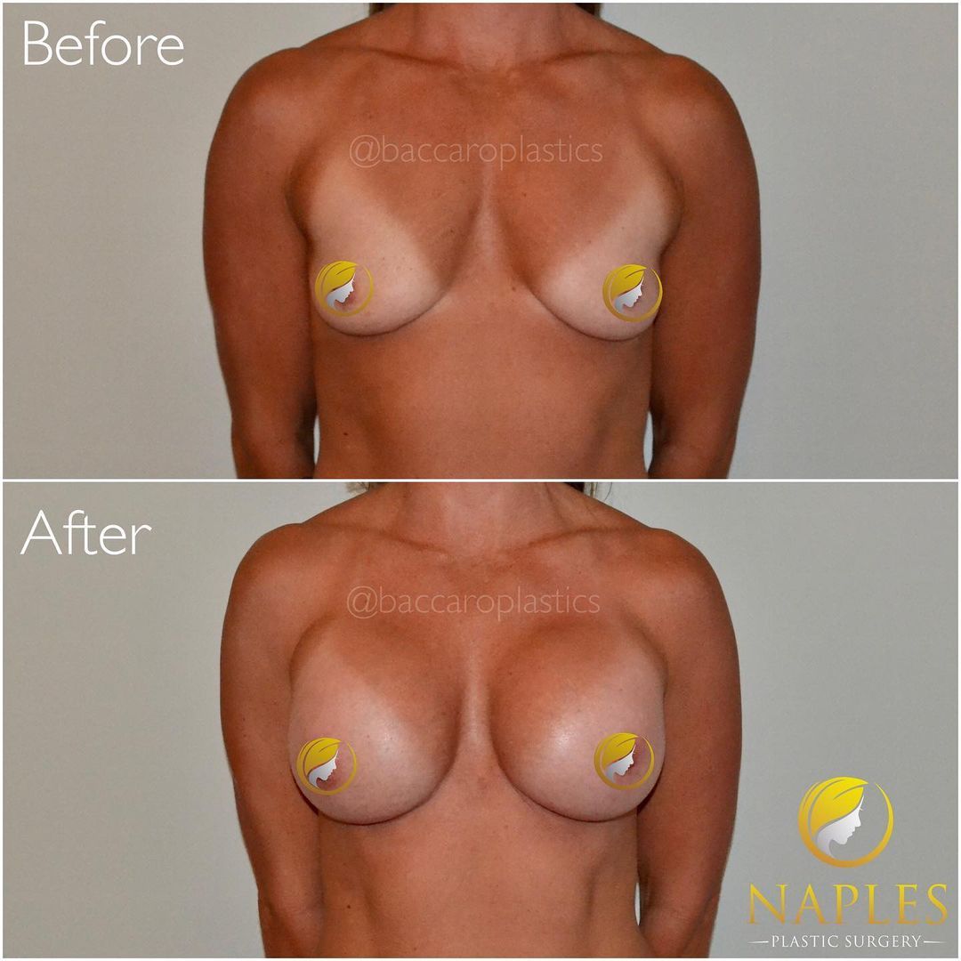 Hybrid Breast Augmentation by Dr. Baccaro