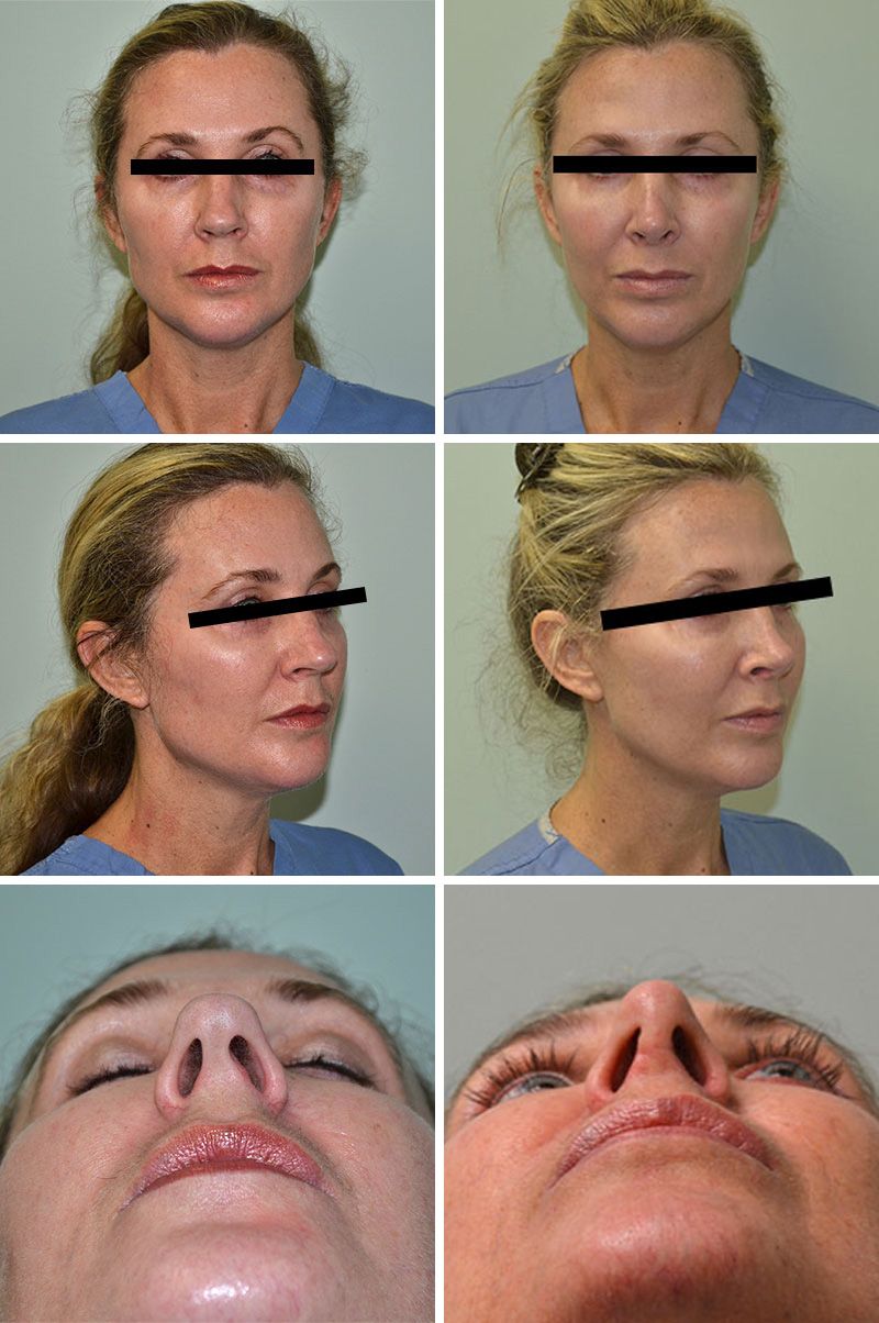 Rhinoplasty Performed by Dr. Baccaro