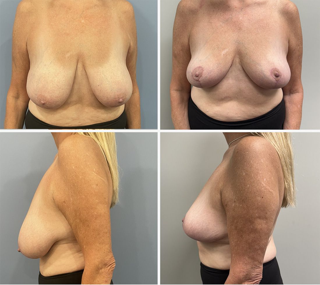 Breast Lift performed by Dr. Walsh
