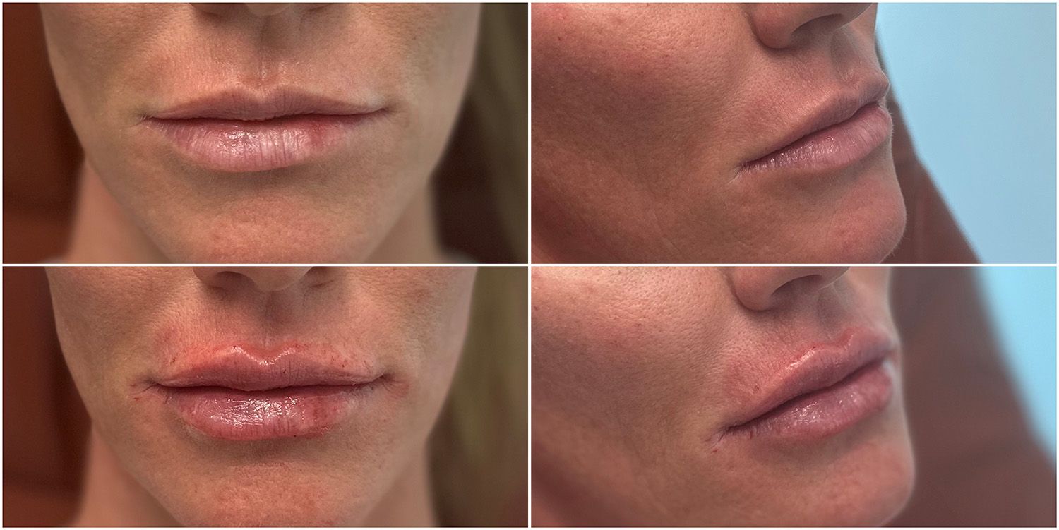 Lip Filler by Dr. Baccaro