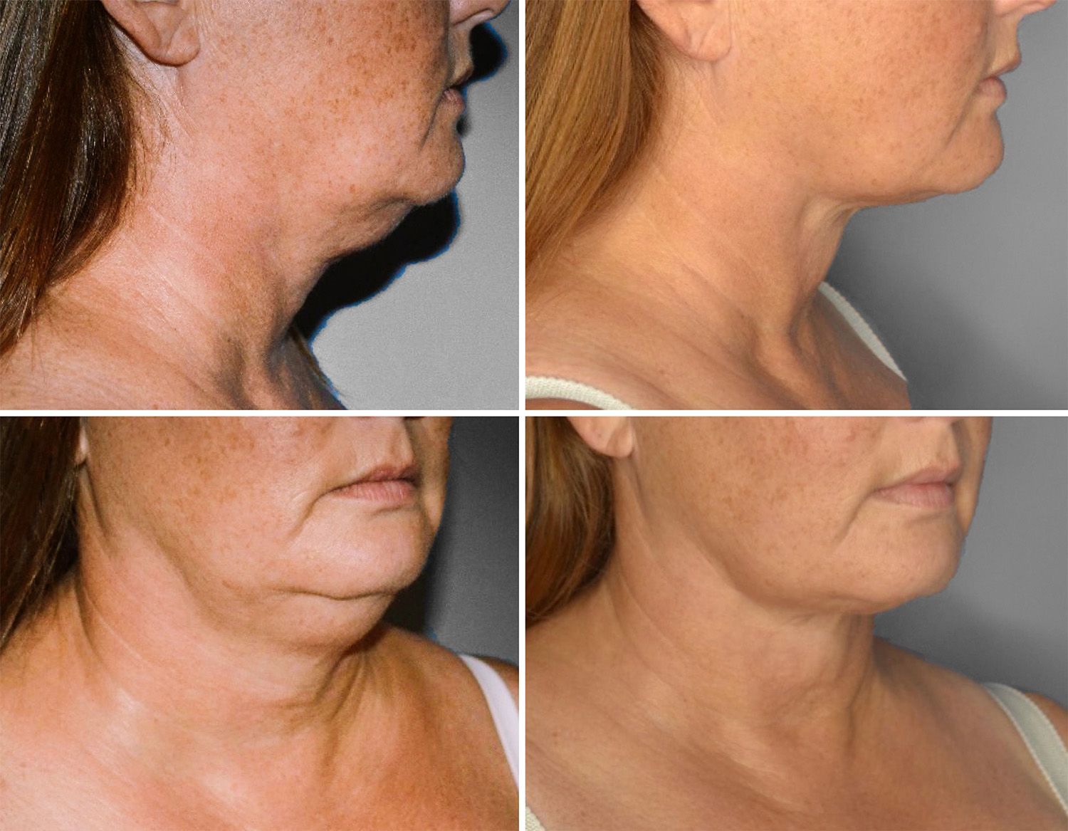 Neck Lipo with Skin Tightening by Dr. Baccaro