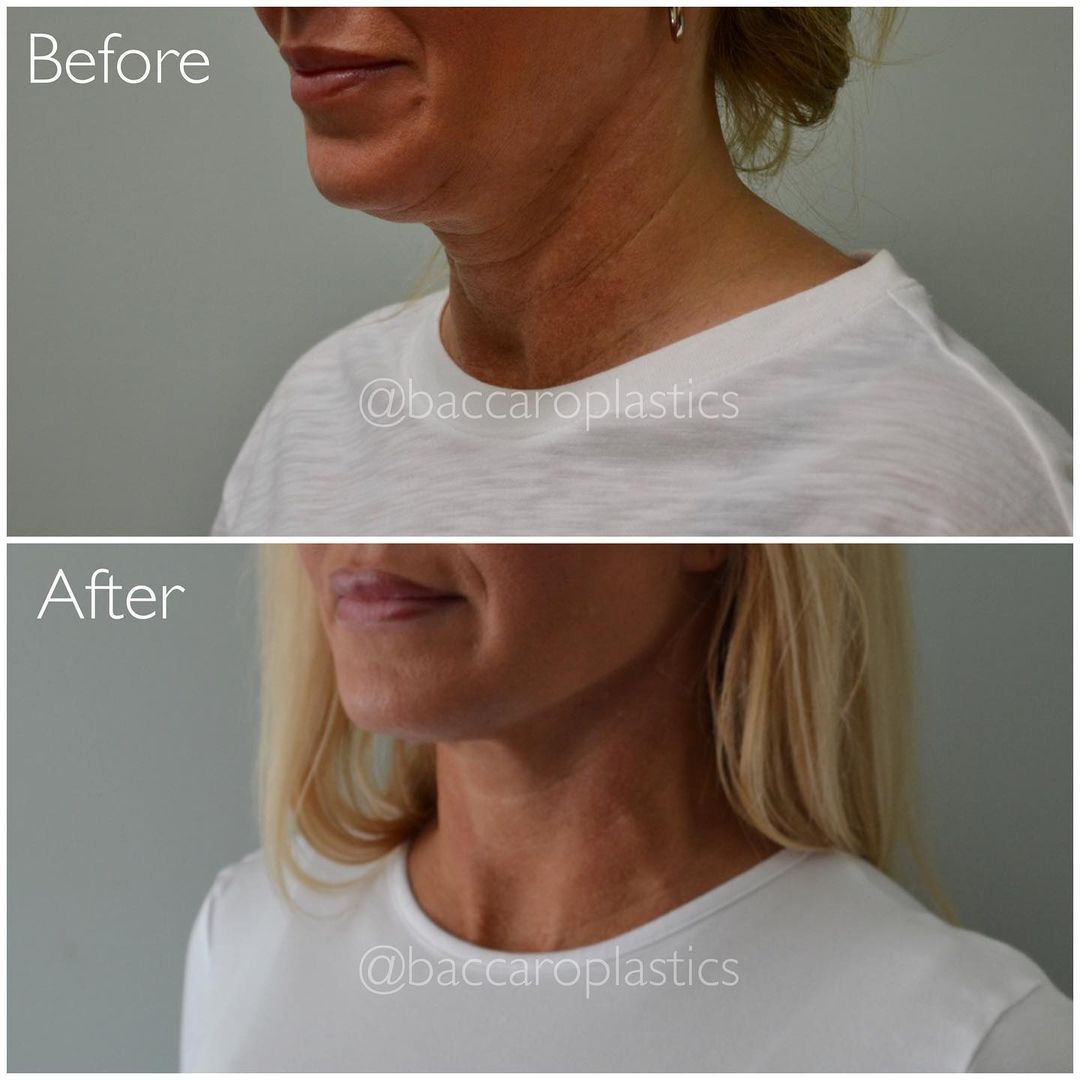 Neck Lift by Dr. Baccaro